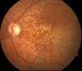 Age-related macular degeneration