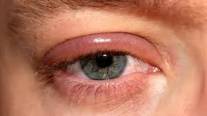 Blepharitis — eyelid inflammation