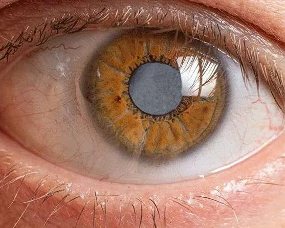 Cataract — clouded eye lens