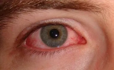 Conjunctivitis — eye infection