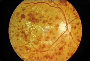 Diabetic retinopathy — retinal damage from diabetes