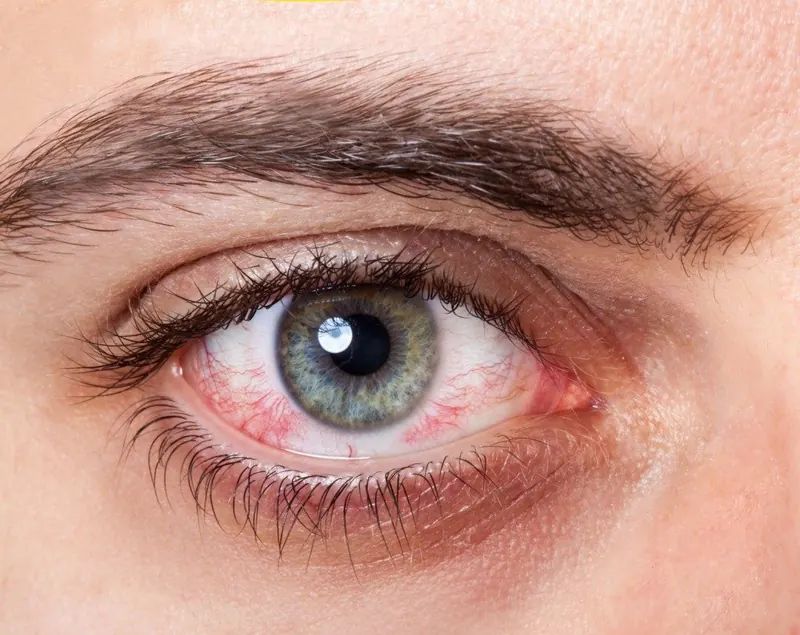 Dry eye syndrome
