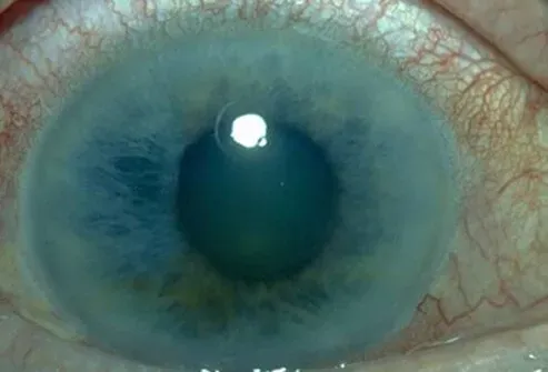 Glaucoma — optic nerve damage
