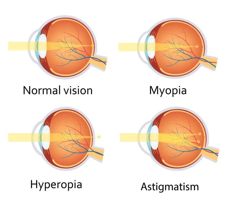 Refractive errors — near/far-sightedness