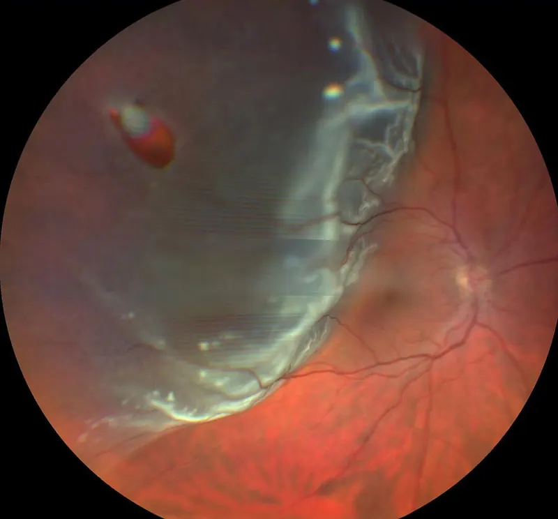 Retinal detachment